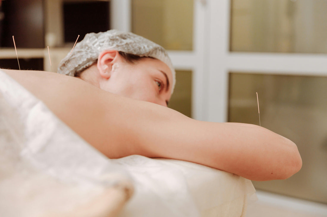 Akupunktur til Vægttab – Virker Det? Og Kan Naturlige Produkter Hjælpe? 🧘‍♀️🍃